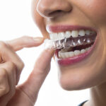 Invisalign clear aligners
