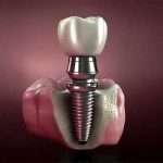 Dental implants