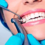 Teeth cleaning